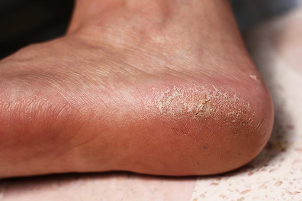 Calluses Skilled Podiatrist Serving Houston TX and surrounding areas