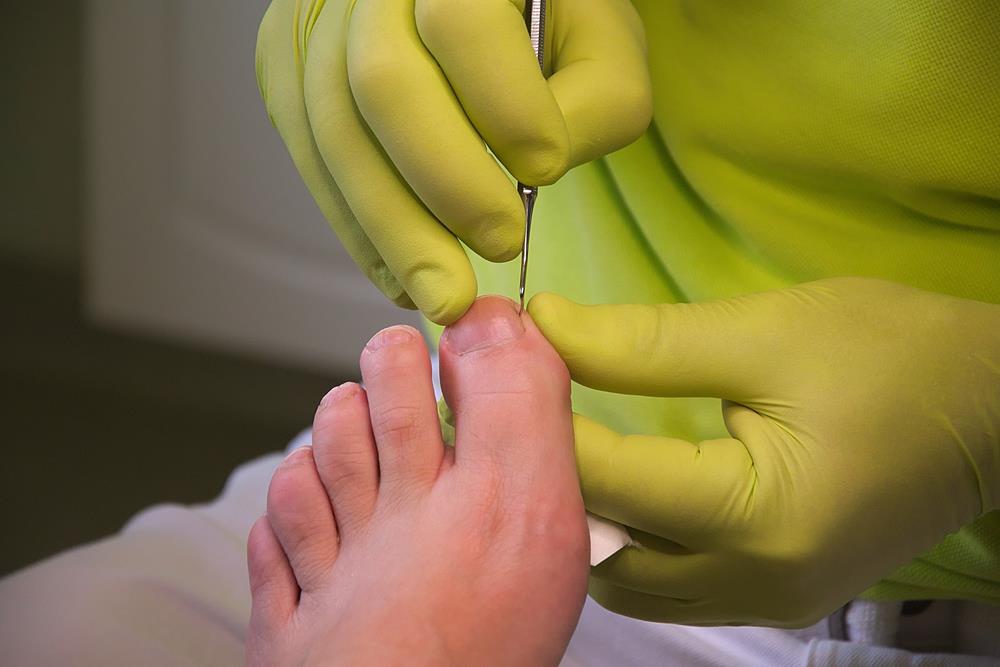Ingrown Toenails Skilled Podiatrist Serving Houston TX and surrounding areas